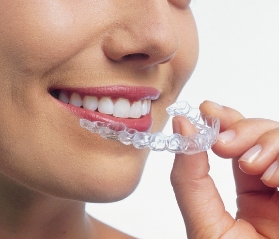 Invisalign_Trio1*.jpg